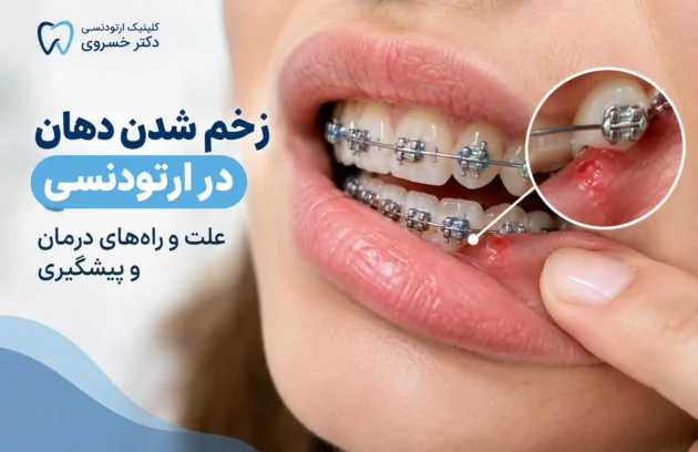 زخم شدن دهان در ارتودنسی و تماس براکت با لب و گونه