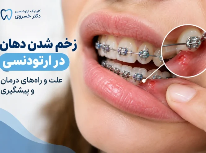 زخم شدن دهان در ارتودنسی و تماس براکت با لب و گونه