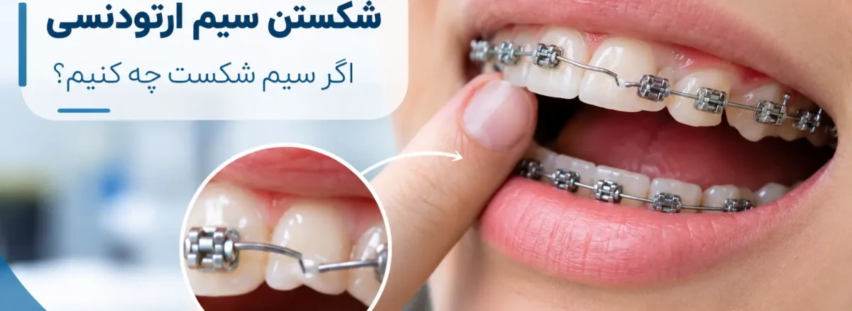 شکستن سیم ارتودنسی و اقدامات لازم برای درمان