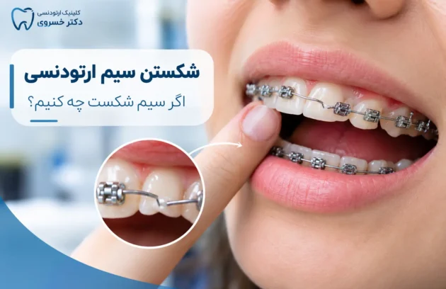 شکستن سیم ارتودنسی و اقدامات لازم برای درمان