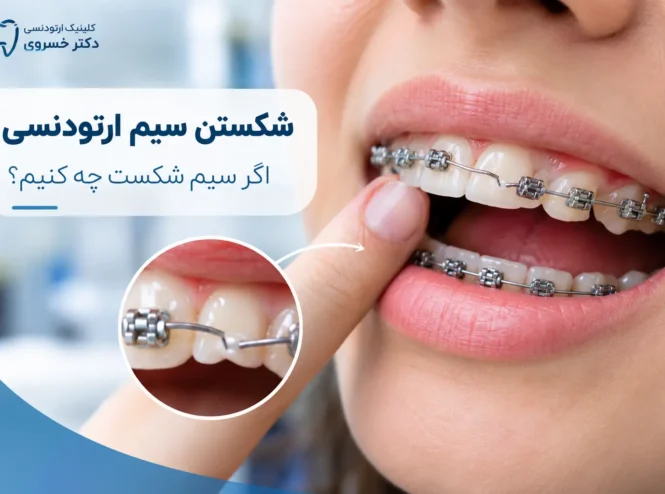 شکستن سیم ارتودنسی و اقدامات لازم برای درمان