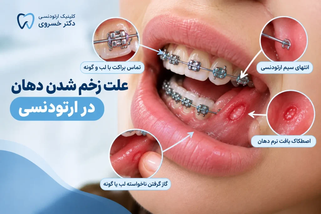 علت زخم شدن دهان در ارتودنسی به دلیل تماس براکت و سیم