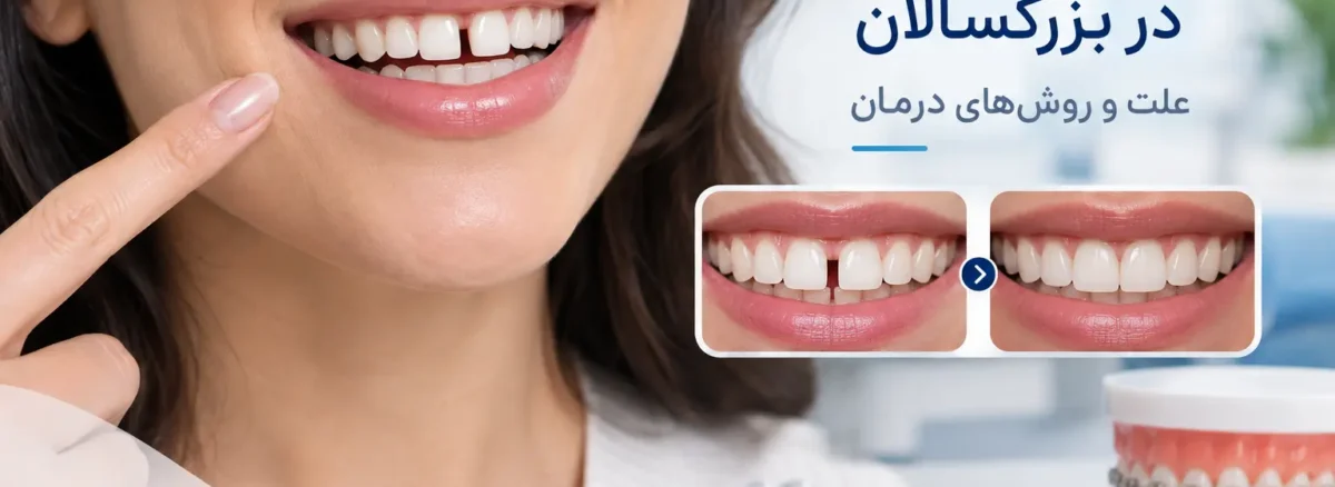 فاصله بین دندان در بزرگسالان و روش درمان