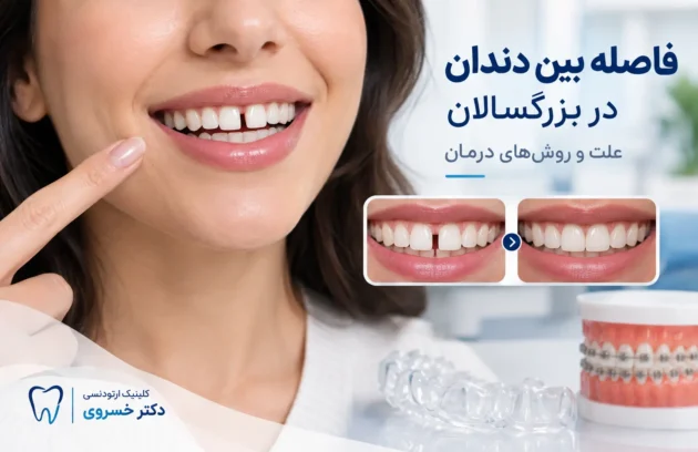 فاصله بین دندان در بزرگسالان و روش درمان