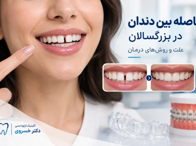فاصله بین دندان در بزرگسالان و روش درمان