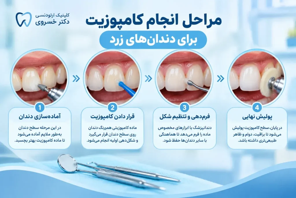 مراحل کامپوزیت دندان زرد از آماده‌سازی تا پولیش
