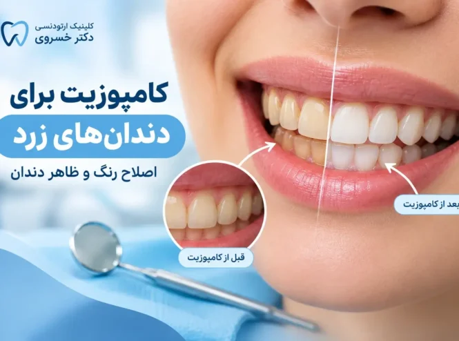 کامپوزیت برای دندان‌های زرد