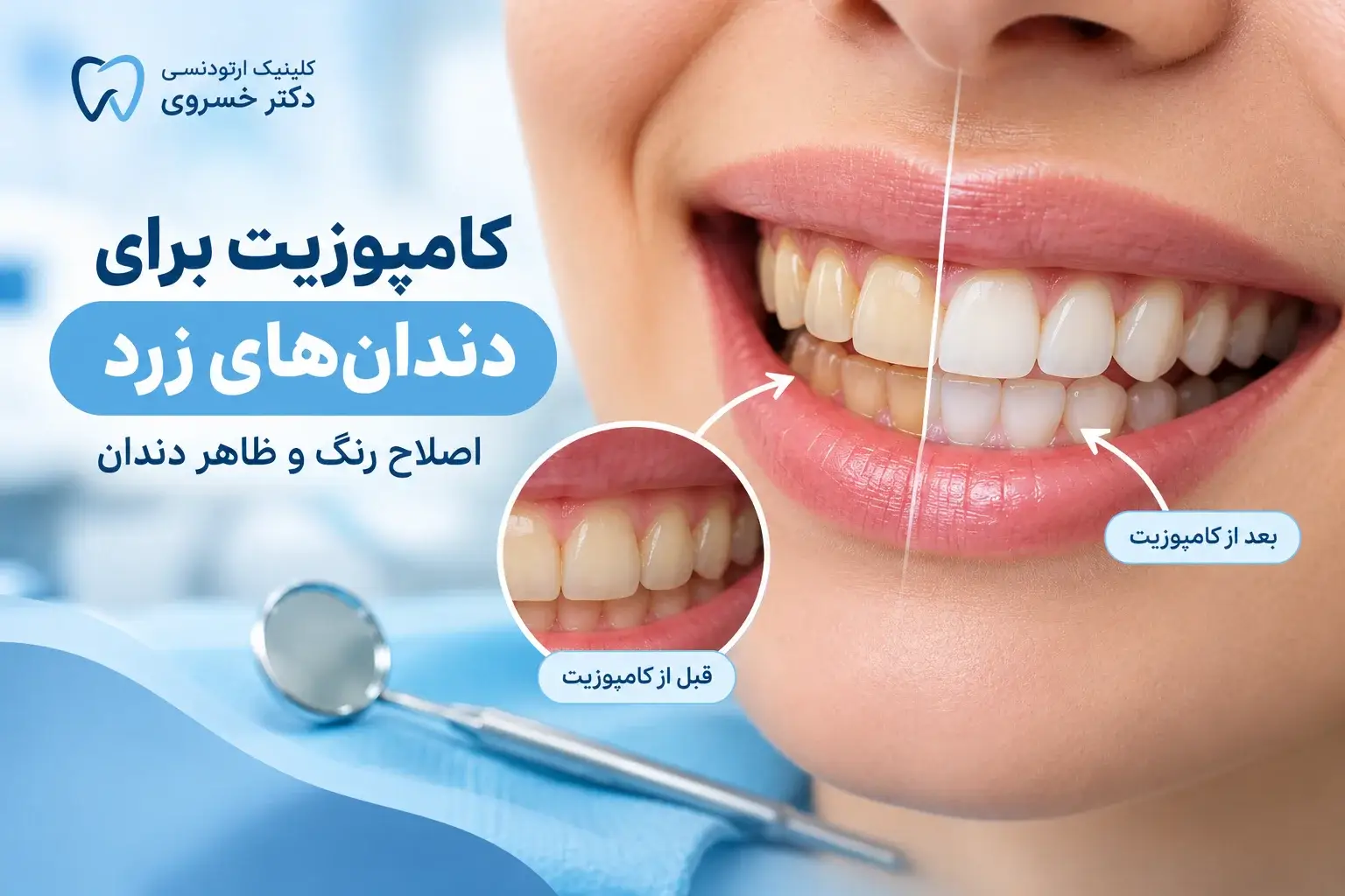 کامپوزیت برای دندان‌های زرد