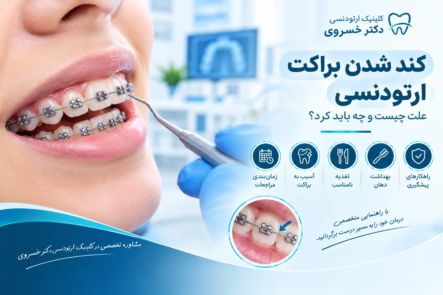 کند شدن براکت ارتودنسی و بررسی سیم و براکت روی دندان