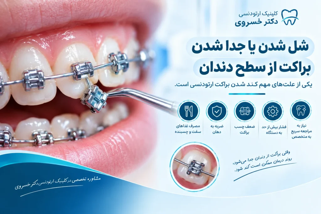 شل شدن براکت ارتودنسی و تأثیر آن بر عملکرد دستگاه