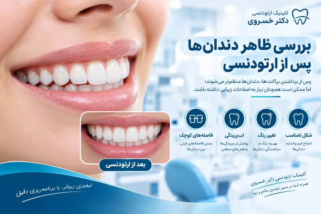 دندان‌های مرتب پس از برداشتن براکت ارتودنسی