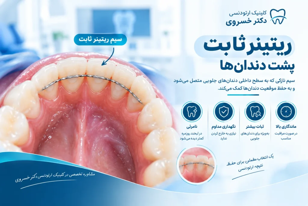 سیم ریتینر ثابت متصل به سطح داخلی دندان‌های جلویی